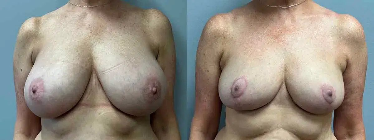 breast reduction before and after photo by main line institute of plastic surgery in wynnewood pa