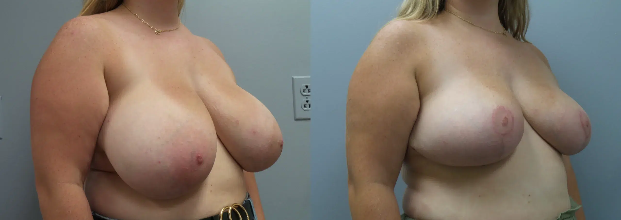 breast reduction before and after photo by main line institute of plastic surgery in wynnewood pa