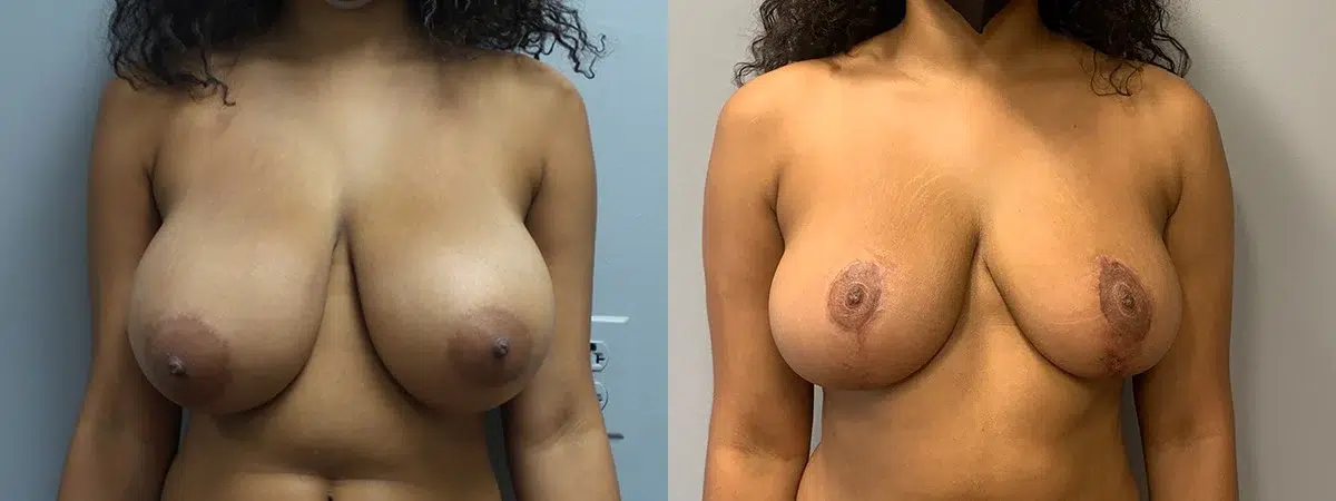 breast reduction before and after photo by main line institute of plastic surgery in wynnewood pa