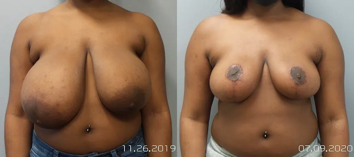 breast reduction before and after photo by main line institute of plastic surgery in wynnewood pa