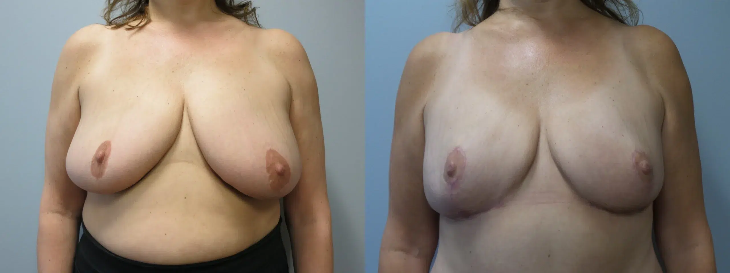 breast reduction before and after photo by main line institute of plastic surgery in wynnewood pa