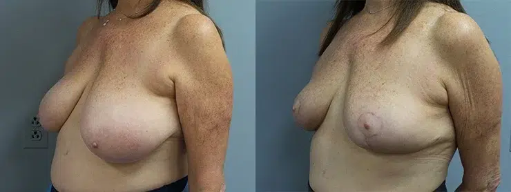 breast reduction before and after photo by main line institute of plastic surgery in wynnewood pa