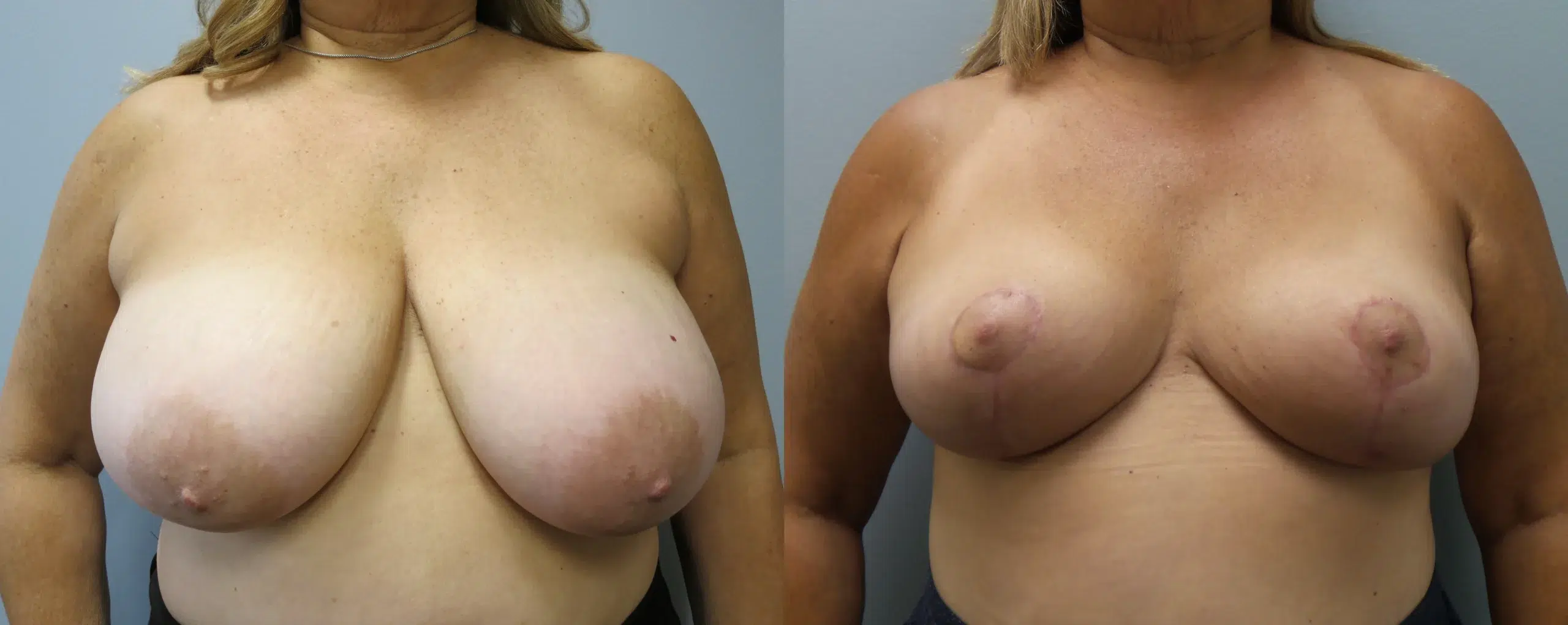 breast reduction before and after photo by main line institute of plastic surgery in wynnewood pa