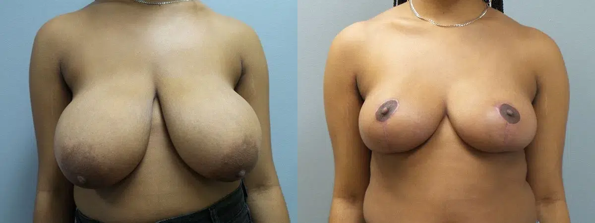 breast reduction before and after photo by main line institute of plastic surgery in wynnewood pa