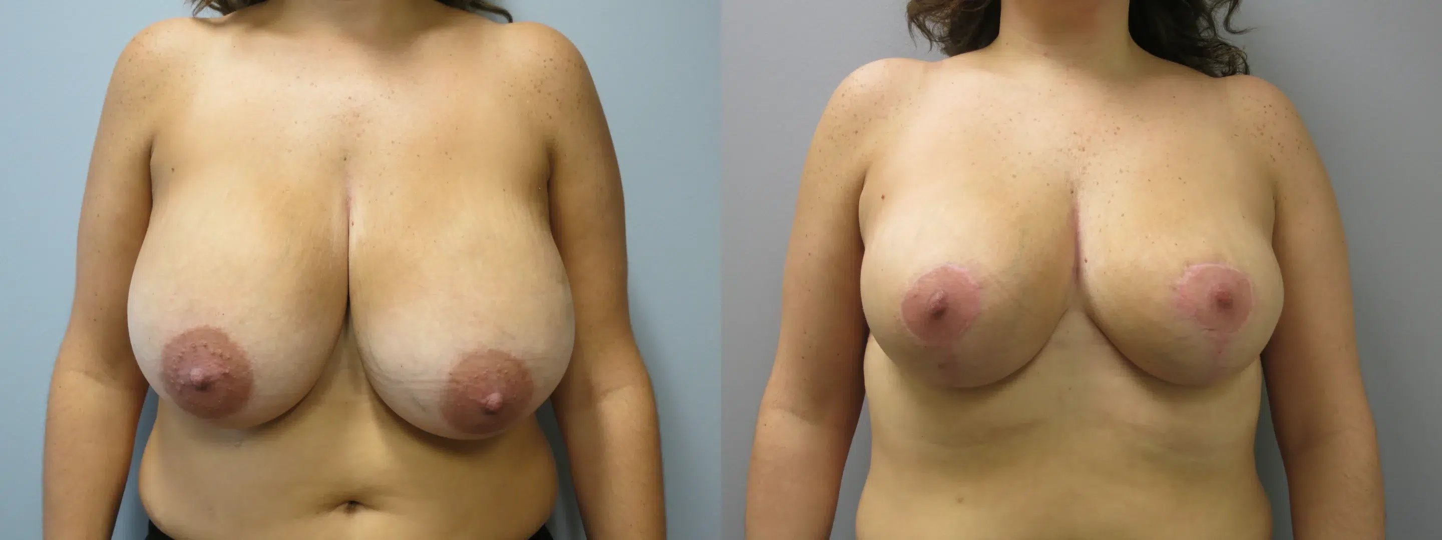 breast reduction before and after photo by main line institute of plastic surgery in wynnewood pa