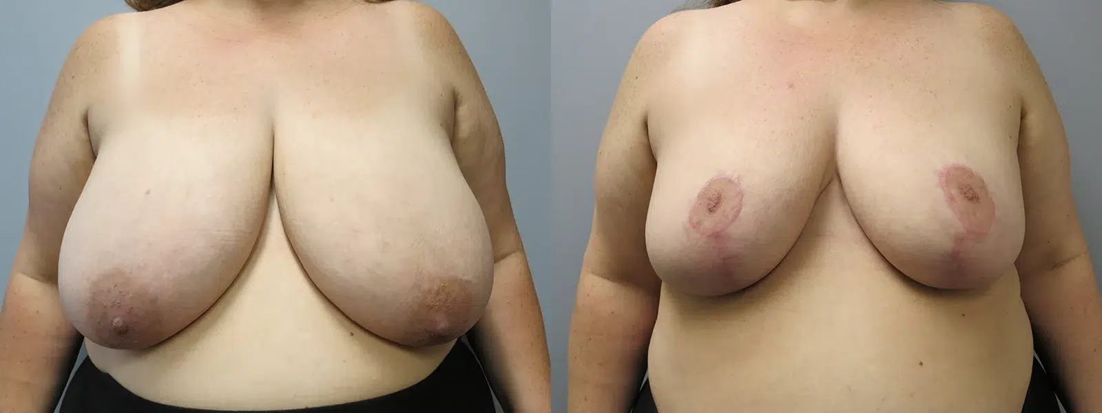 breast reduction before and after photo by main line institute of plastic surgery in wynnewood pa