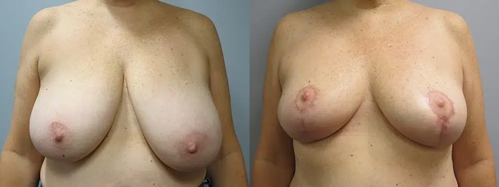 breast reduction before and after photo by main line institute of plastic surgery in wynnewood pa