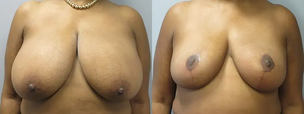 breast reduction before and after photo by main line institute of plastic surgery in wynnewood pa