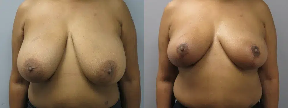breast reduction before and after photo by main line institute of plastic surgery in wynnewood pa