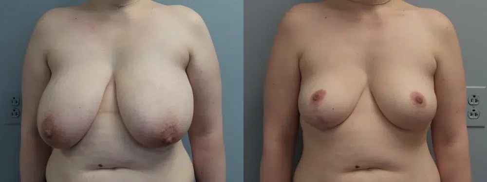breast reduction before and after photo by main line institute of plastic surgery in wynnewood pa