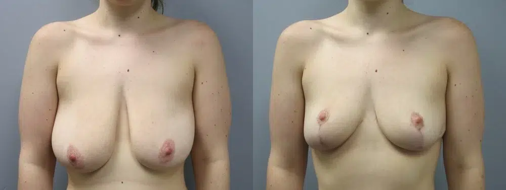 breast reduction before and after photo by main line institute of plastic surgery in wynnewood pa