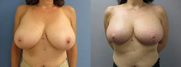 breast reduction before and after photo by main line institute of plastic surgery in wynnewood pa