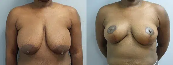breast reduction before and after photo by main line institute of plastic surgery in wynnewood pa