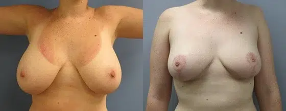 breast reduction before and after photo by main line institute of plastic surgery in wynnewood pa
