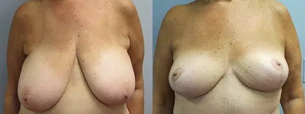 breast reduction before and after photo by main line institute of plastic surgery in wynnewood pa