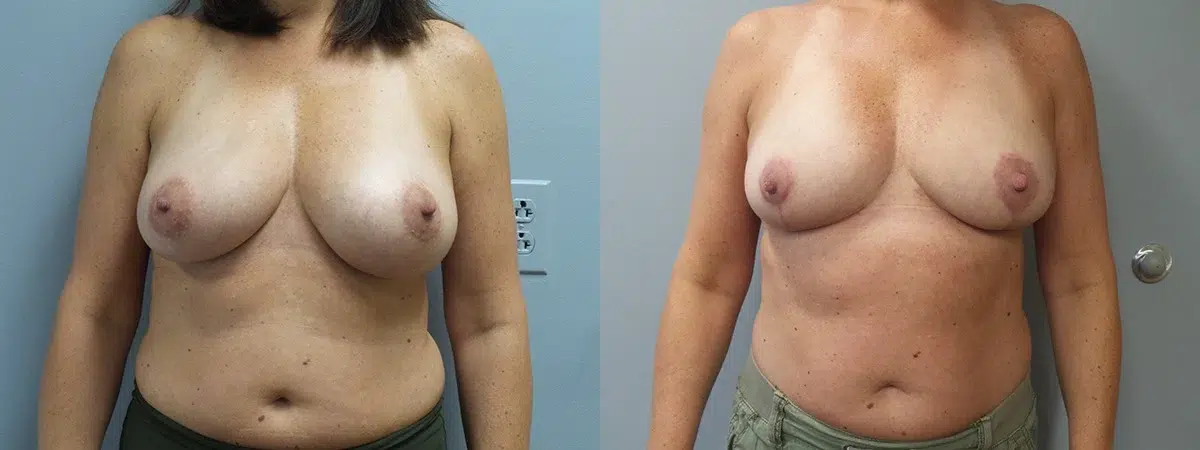 breast reduction before and after photo by main line institute of plastic surgery in wynnewood pa
