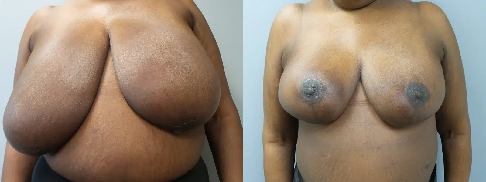 breast reduction before and after photo by main line institute of plastic surgery in wynnewood pa