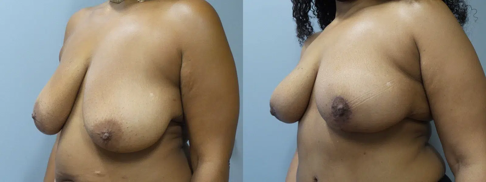 breast reduction before and after photo by main line institute of plastic surgery in wynnewood pa