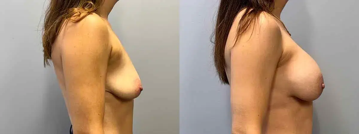 breast augmentation before and after photo by main line institute of plastic surgery in wynnewood pa