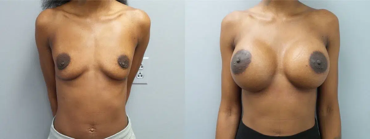 breast augmentation before and after photo by main line institute of plastic surgery in wynnewood pa