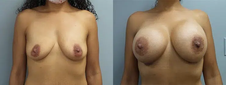 breast augmentation before and after photo by main line institute of plastic surgery in wynnewood pa