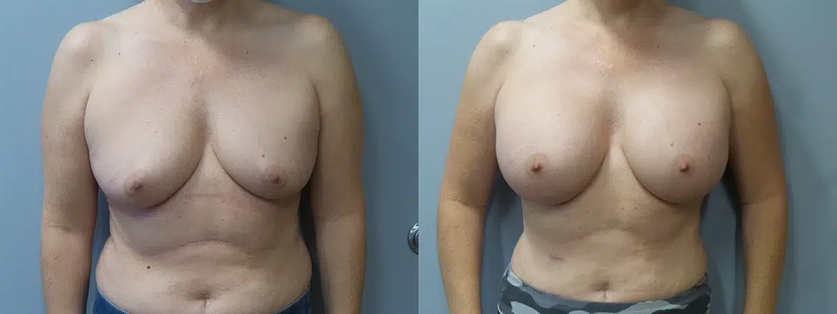 breast augmentation before and after photo by main line institute of plastic surgery in wynnewood pa