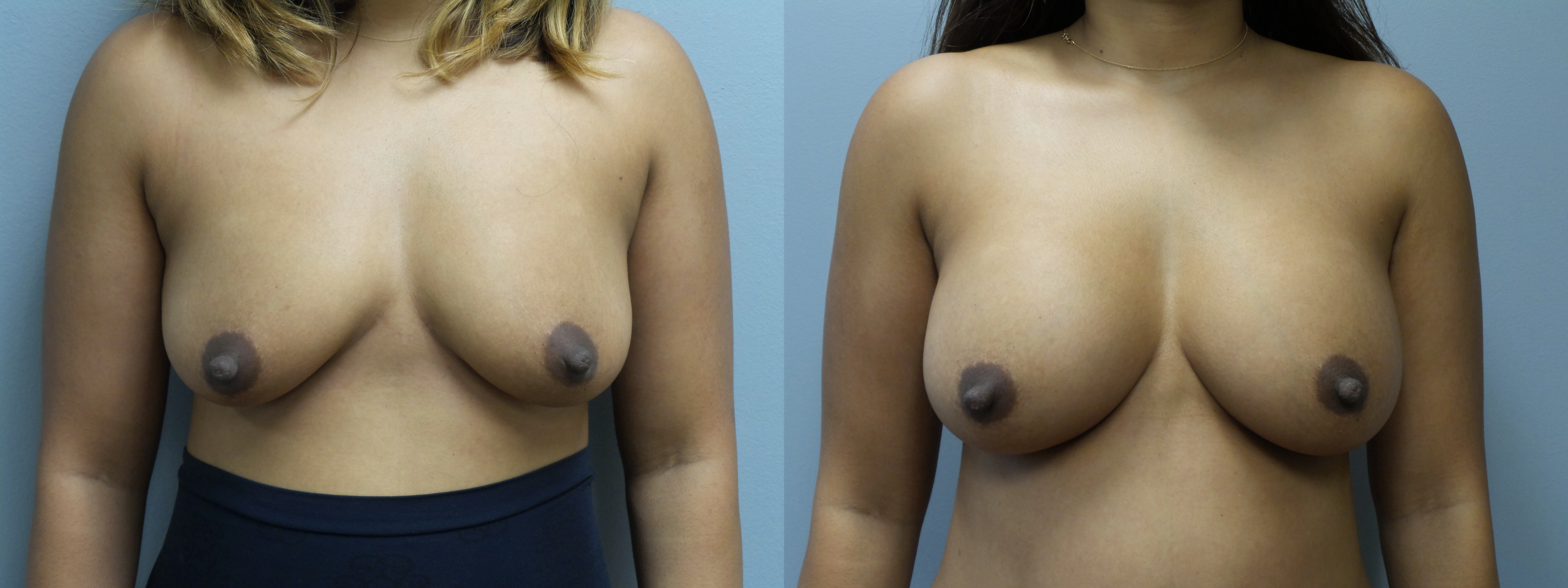 breast augmentation before and after photo by main line institute of plastic surgery in wynnewood pa