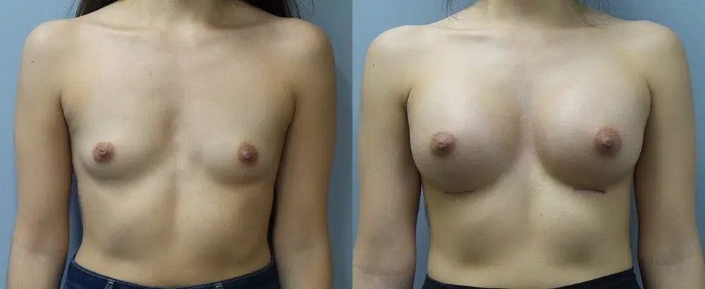breast augmentation before and after photo by main line institute of plastic surgery in wynnewood pa