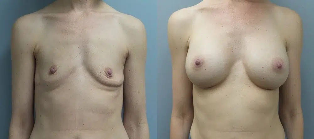 breast augmentation before and after photo by main line institute of plastic surgery in wynnewood pa