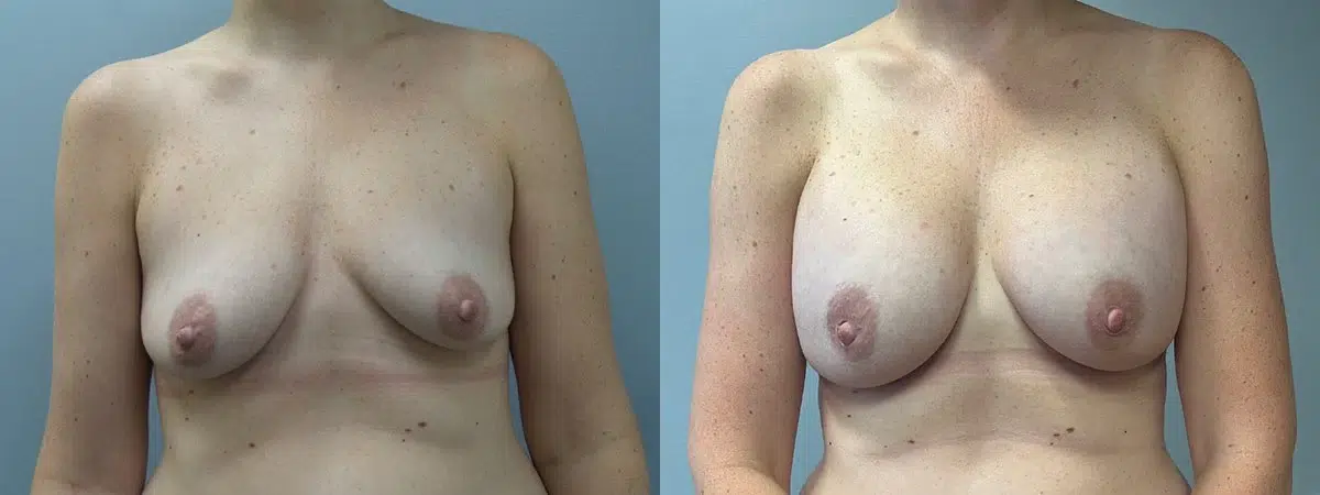 breast augmentation before and after photo by main line institute of plastic surgery in wynnewood pa