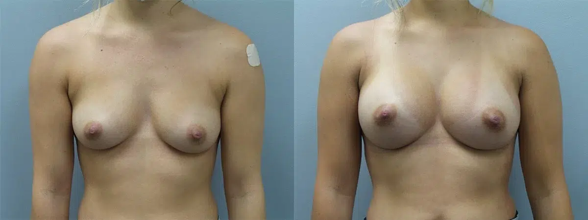 breast augmentation before and after photo by main line institute of plastic surgery in wynnewood pa