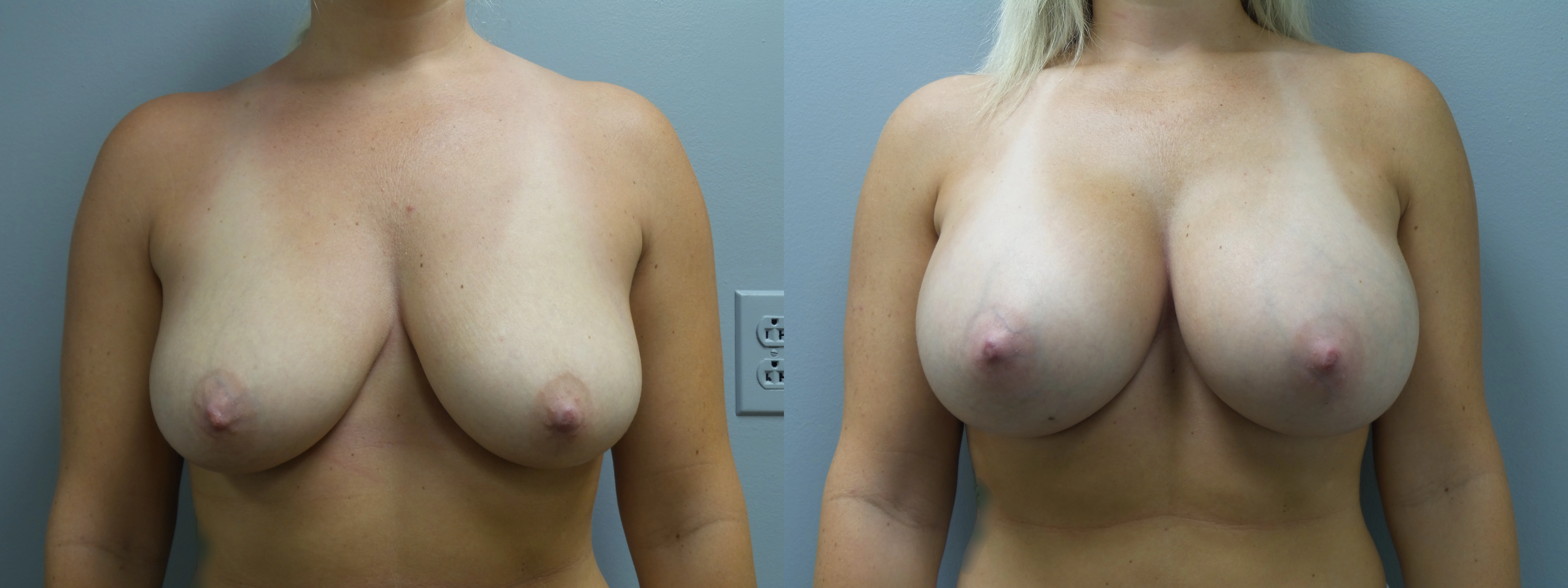 breast augmentation before and after photo by main line institute of plastic surgery in wynnewood pa