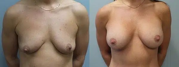breast augmentation before and after photo by main line institute of plastic surgery in wynnewood pa