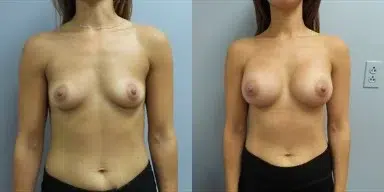 breast augmentation before and after photo by main line institute of plastic surgery in wynnewood pa