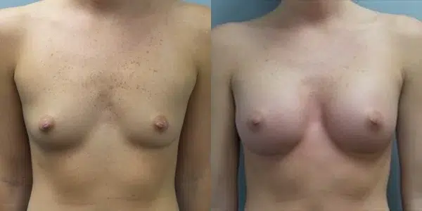 breast augmentation before and after photo by main line institute of plastic surgery in wynnewood pa