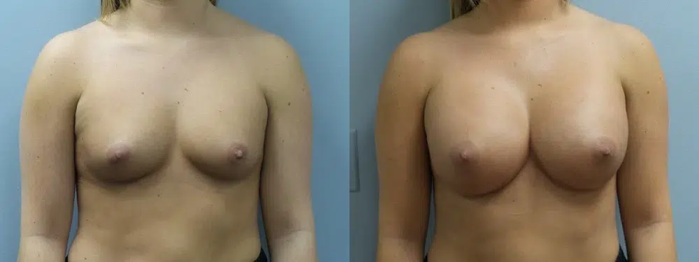 breast augmentation before and after photo by main line institute of plastic surgery in wynnewood pa