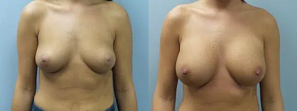breast augmentation before and after photo by main line institute of plastic surgery in wynnewood pa