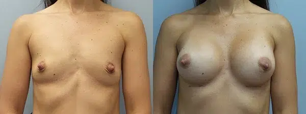 breast augmentation before and after photo by main line institute of plastic surgery in wynnewood pa