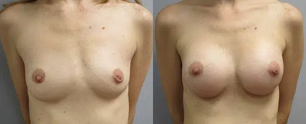 breast augmentation before and after photo by main line institute of plastic surgery in wynnewood pa