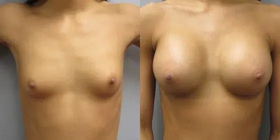 breast augmentation before and after photo by main line institute of plastic surgery in wynnewood pa
