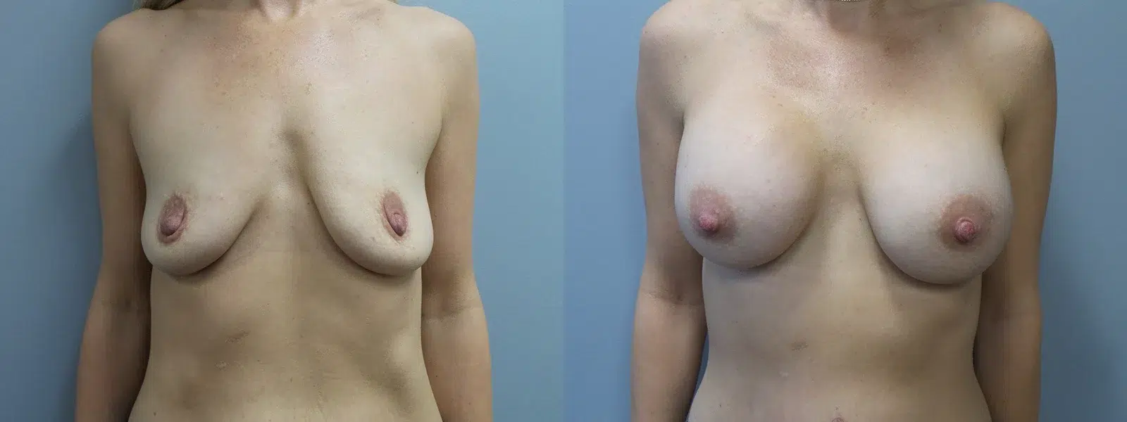 breast augmentation before and after photo by main line institute of plastic surgery in wynnewood pa