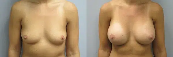 breast augmentation before and after photo by main line institute of plastic surgery in wynnewood pa