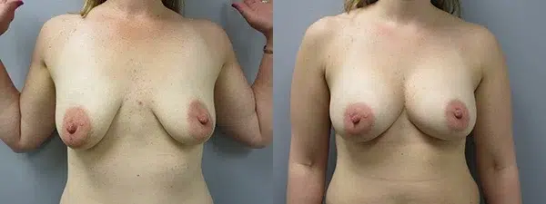 breast augmentation before and after photo by main line institute of plastic surgery in wynnewood pa