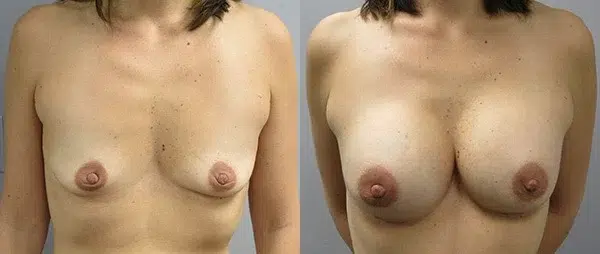 breast augmentation before and after photo by main line institute of plastic surgery in wynnewood pa
