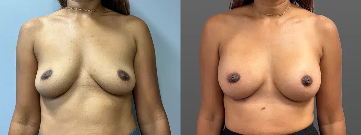 breast augmentation before and after photo by main line institute of plastic surgery in wynnewood pa