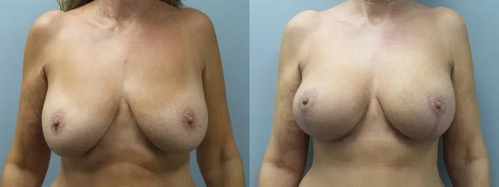 breast lift mastopexy with augmentation before and after photo by main line institute of plastic surgery in wynnewood pa