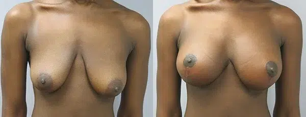 breast lift mastopexy with augmentation before and after photo by main line institute of plastic surgery in wynnewood pa