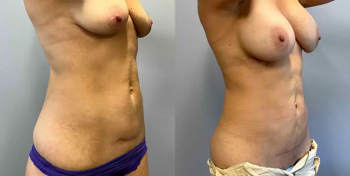 mommy makeover before and after photo by main line institute of plastic surgery in wynnewood pa