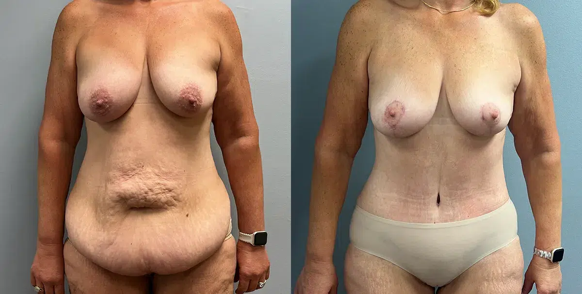 mommy makeover before and after photo by main line institute of plastic surgery in wynnewood pa