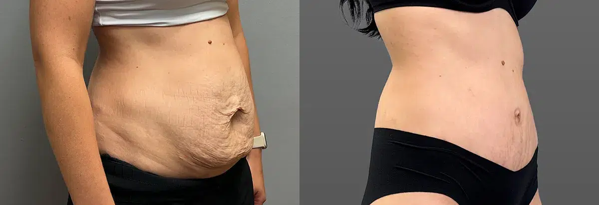 tummy tuck abdominoplasty before and after photo by main line institute of plastic surgery in wynnewood pa